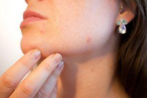 7 Proven Home Remedies to Banish Cold Sores Fast!